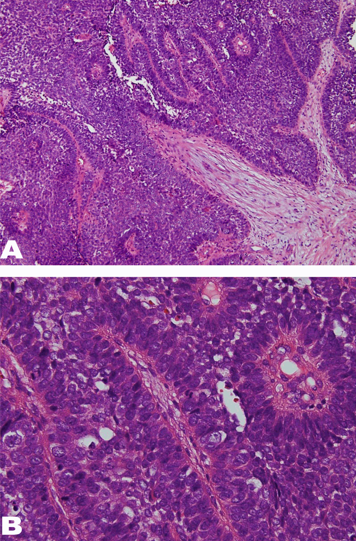 FULL TEXT - Basaloid squamous cell carcinoma of the oral cavity: A case